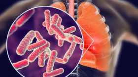 В Вологодской области снижается заболеваемость туберкулезом