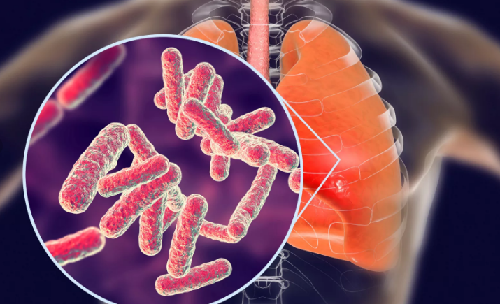 В Вологодской области снижается заболеваемость туберкулезом