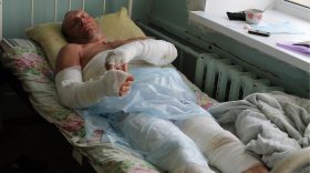 Житель Вологодской области получил тяжелые ожоги, борясь с борщевиком