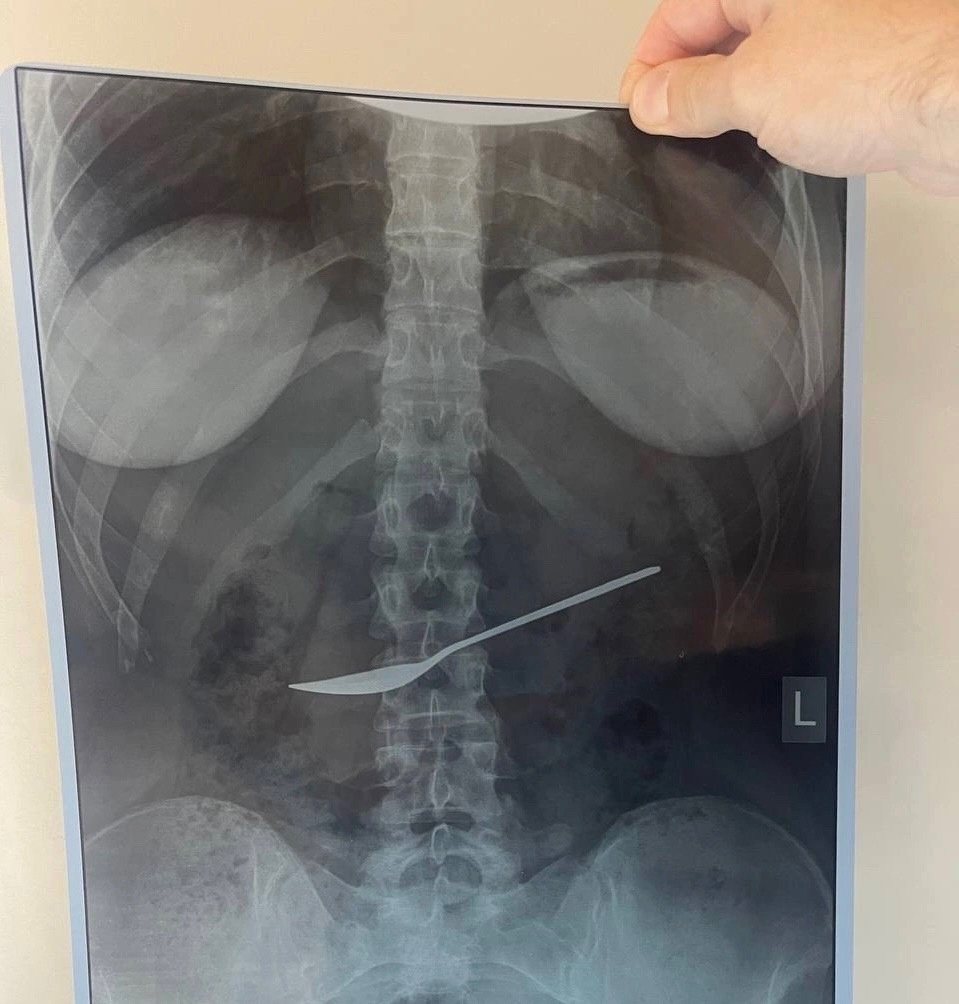 Вологодские врачи извлекли из желудка пациентки металлическую ложку