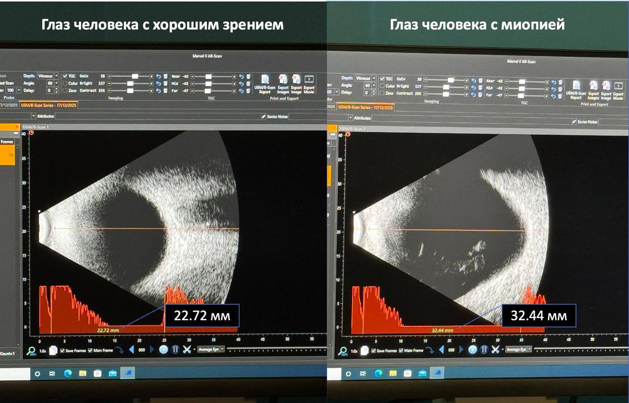 В Вологде вернули зрение мужчине с близорукостью -30